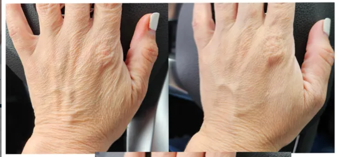 Numiere Hand Glow – LED Light Therapy for Hand & Wrist Rejuvenation