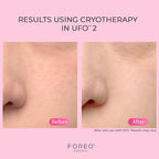 FOREO UFO™ 2 with 7pc day mask and 7pc night mask
